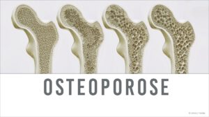 Read more about the article Osteoporose, wenn Knochen plötzlich brechen!