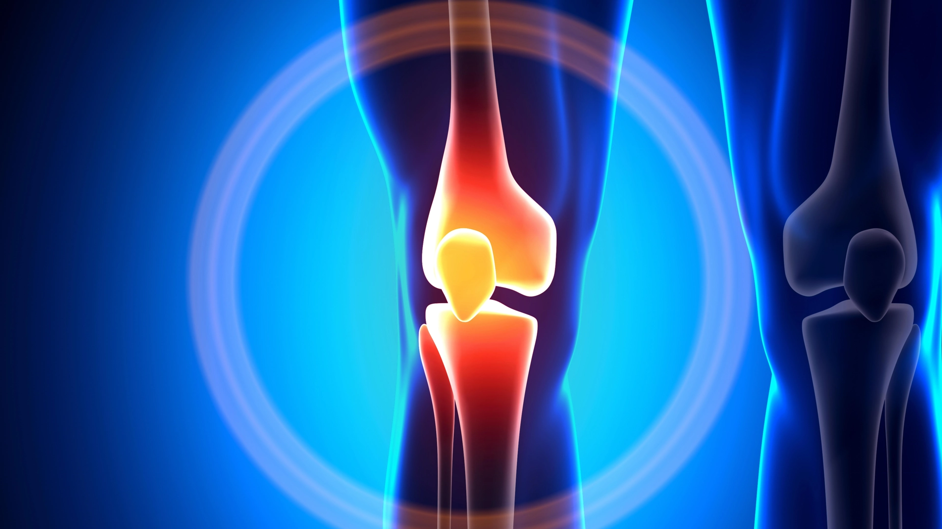 Read more about the article Was ist eine Osteochondrosis dissecans?